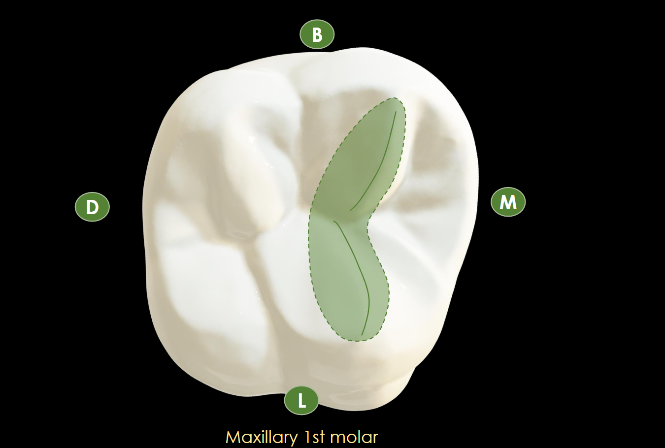 <p>Union of 2 triangular ridges (buccal cusp + lingual cusp) crossing transversely<br>ONLY on posterior teeth; present in multiple posterior teeth<br></p>