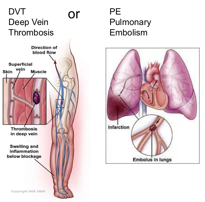 <p>Prevention of deep vein thrombosis and pulmonary embolism</p><ul><li><p>DVT - clot forms in deep vein of legs (can be in arms). Can be asymptomatic until too late (shortness of breath)</p></li><li><p>PE - artery in lung is blocked by a clot</p></li></ul><p></p>