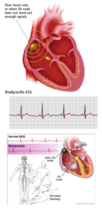 <ul><li><p>resting HR less than 60 bpm </p></li></ul><p></p>