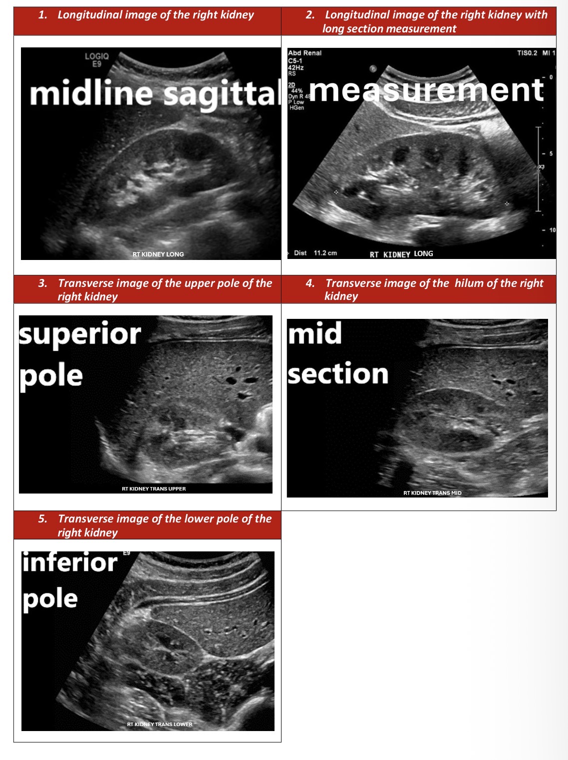 <p>After surveying the entire kidney. </p><p>Find the longitudinal axis once more, ensure you have the longest length of the kidney (image one) </p><p>Now do a measurement (image two)</p><p>Turn into a transverse plane and identify the upper pole of the kidney, obtain an image demonstrating the round doughnut shape of the parenchyma above the hilium (Image three) </p><p>Slide inferiorly and obtain a transverse image of the hilum showing the C shaped parenchyma around the renal pelvis (image four) </p><p>Slide further inferiorly and obtain a transverse image of the lower pole of the kidney demonstrating the round doughnut shape of the parenchyma below the hilum. (Image 5) </p>