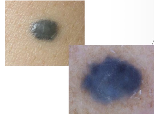 <p>Melanoma w/ blue-black areas:</p><ul><li><p>blue-black areas very concerning ESP if asymmetric</p></li></ul><p>MIMIC: Blue Nevus</p><ul><li><p>homogenous blue-gray appearance both clinically and dermoscopy</p></li></ul><p></p>