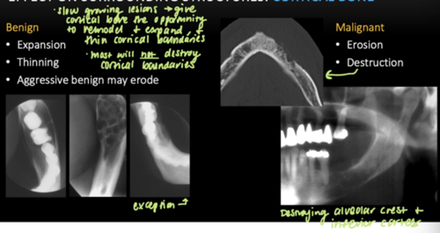 <p>Benign:</p><p>- Expansion </p><p>- Thinning </p><p>-- these are slow growing lesions, which gives cortical bone the opportunity to grow and expand, thin cortical boundaries </p><p>- Aggressive benign may erode </p><p>Malignant:</p><p>- Erosion </p><p>- Destruction </p>