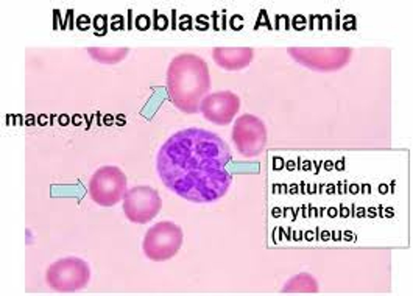 <p>Megaloblastic anemia</p>
