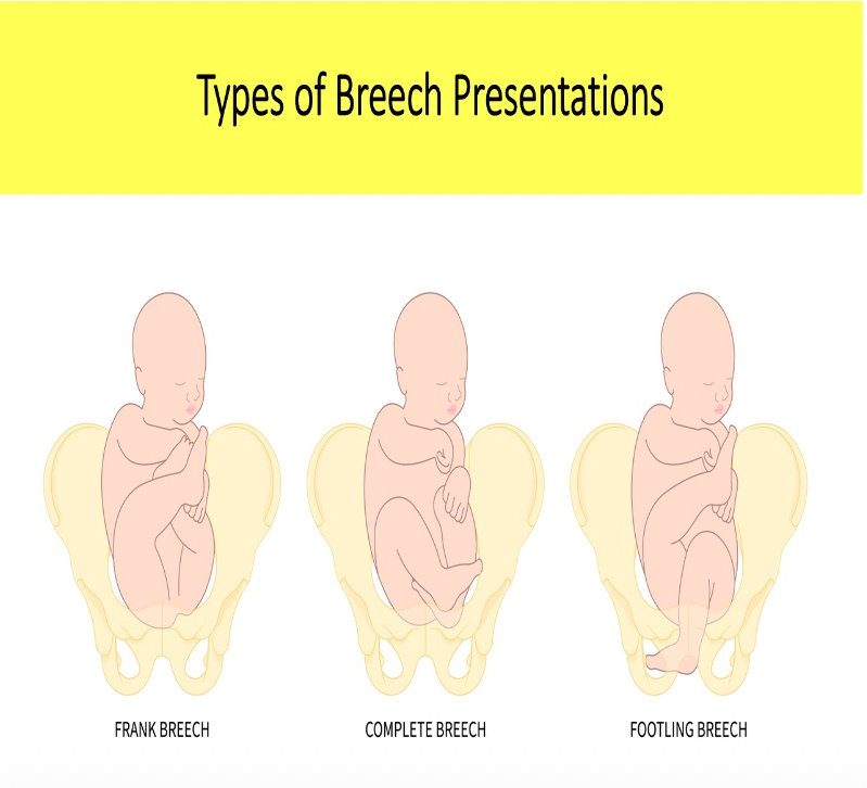 <p>B. Frank</p><p>Frank breech = butt down legs straight up in front of abdomen</p><p class="p1">Complete breech = butt down legs folded, knees bent, ankles crossed</p><p class="p1">Footling breech = feet down, baby "standing" on cervix</p>