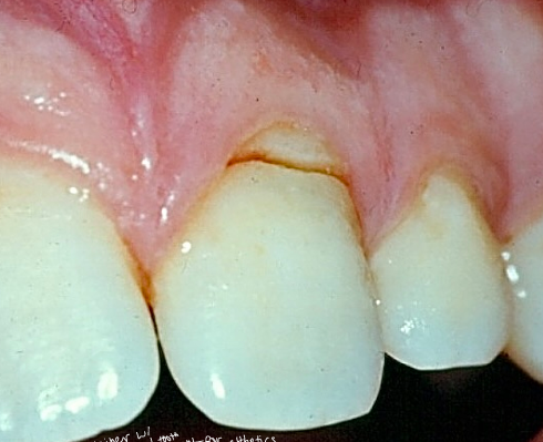 <p>-outcome/treatment will depend on age of patient</p><p>-adult: don’t worry, can extract and implant</p><p>-child/adolescent: don’t want to extract- could compromise the alveolus; want to preserve the root, extract coronal segment, bury root under bone and use retention (essix retainer) for esthetics, when pt turns 18 could do implant then since the ridge will have been preserved</p>