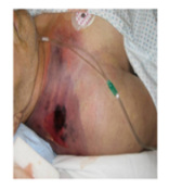 <p>Identify the following disease based upon the physical manifestation: </p><p>A. Gas gangrene</p><p>B. Tetanus</p><p>C. Hansen’s disease</p><p>D. Anthrax</p>