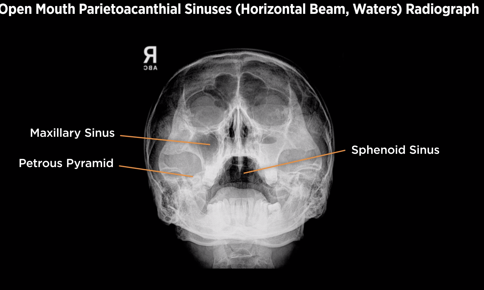 <p>Open-Mouth Parietoacanthial Sinuses (Waters)</p>