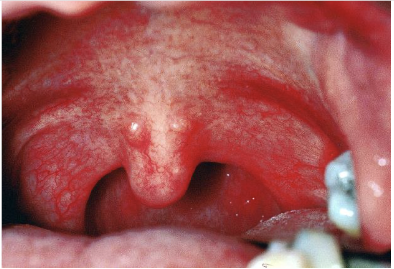 <p>what are these lesions associated with </p>