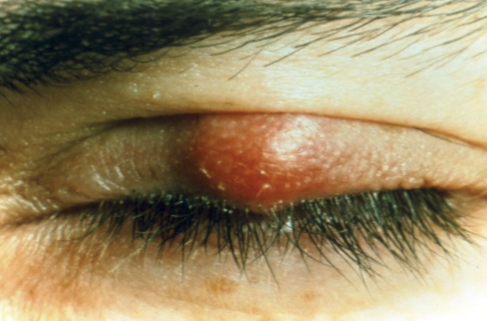 <ul><li><p>Redness </p></li><li><p>Pain </p></li><li><p>Warm to touch</p></li><li><p>Painful to touch</p></li><li><p>Soft in texture: filled w/ puss</p></li><li><p>Isolated </p></li></ul><p></p>