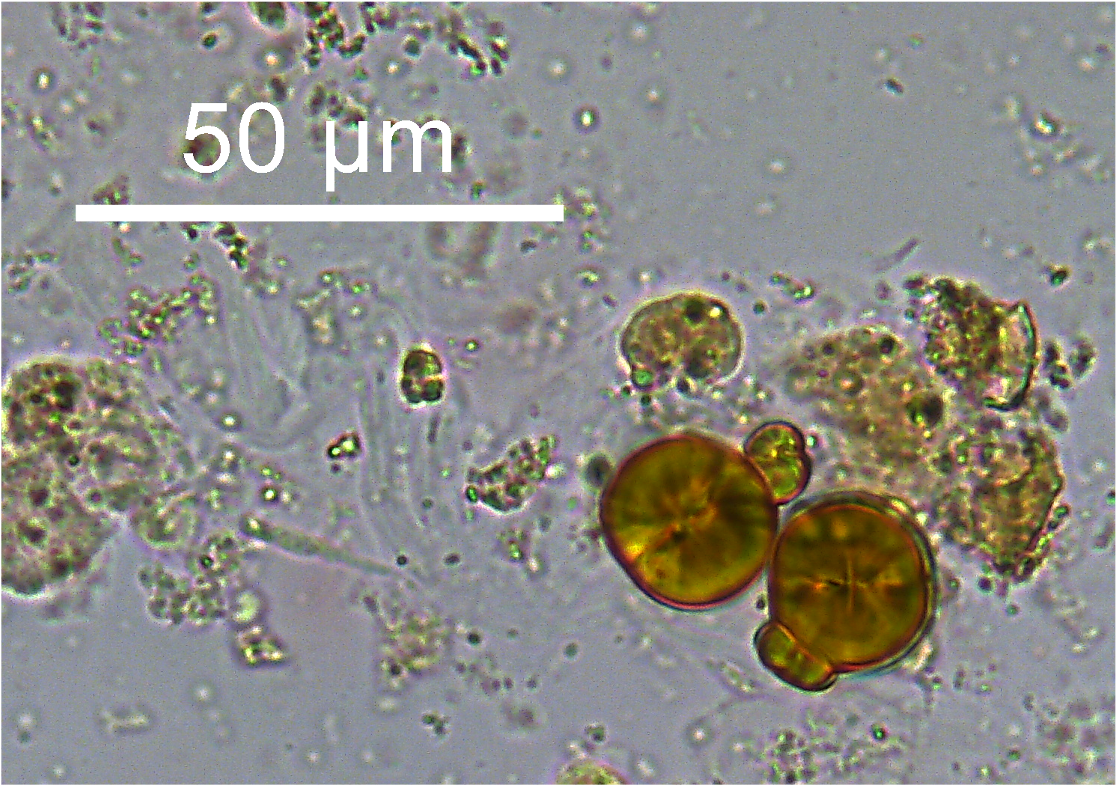 <p>Abnormal (acidic urine). Yellow/brown spheres with radial striations</p><p>When found alone, suggests rare inherited metabolic disorder</p>