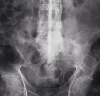 <p>Ankylosing Spondylitis <span data-name="star" data-type="emoji">⭐</span></p>