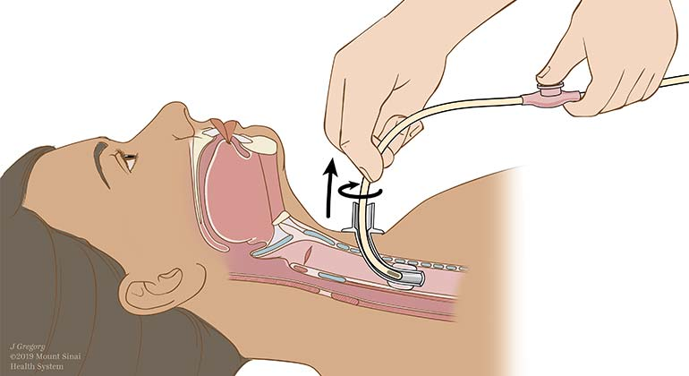 <p>Once the catheder is inserted, you can activate suctioning, how LONG do you suction for?</p><p>and how long do you wait to section again?</p>