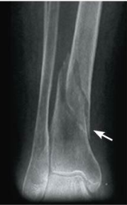 <p>what fracture is this?</p>