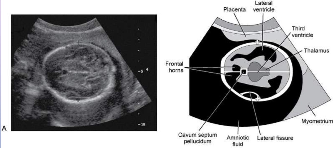 <p>Transducer must be perpendicular to parietal bones and positioned to intersect 3rd ventricle and thalami; measure from outer anterior edge to inner posterior edge of calvarial wall (important to recognize correct plane of section to obtain accurate and consistent measurements of BPD)</p>