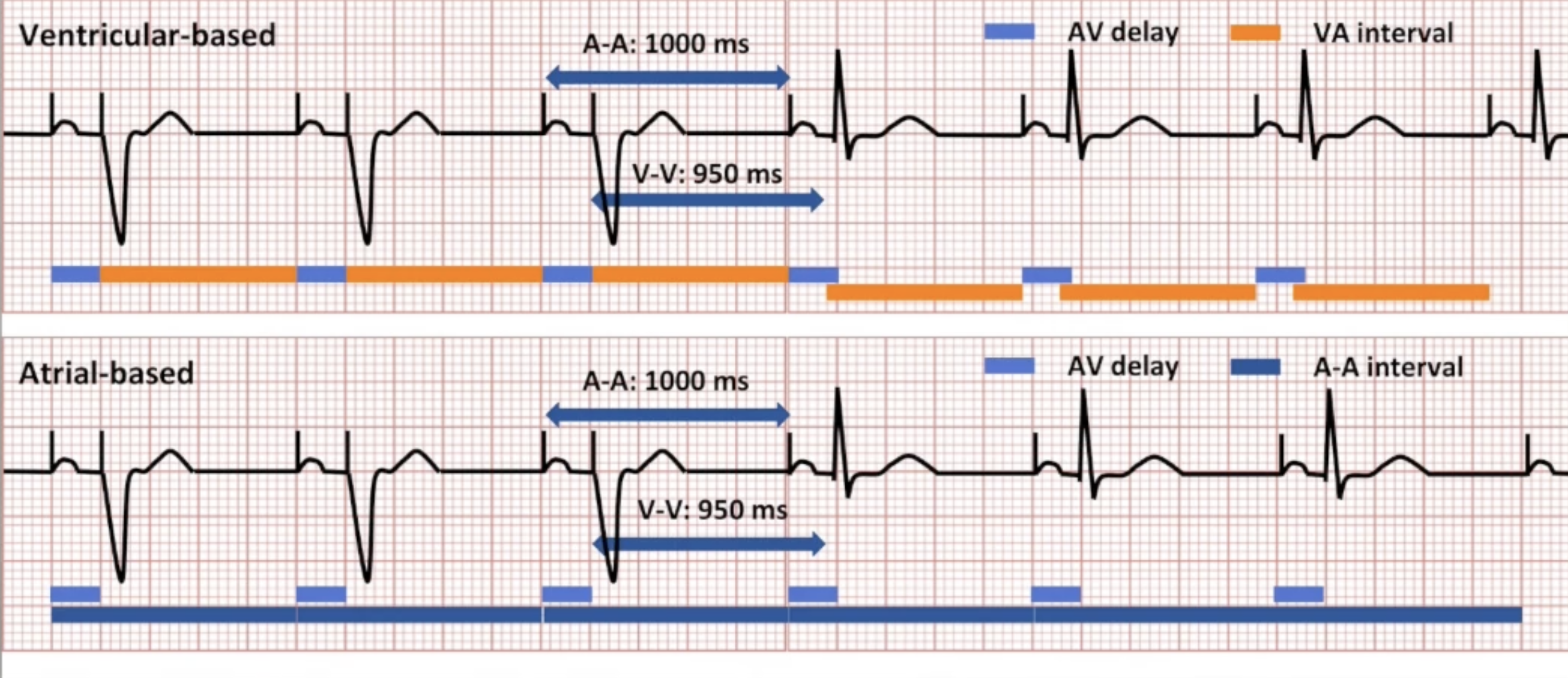 <p>Ventricle-based vs Atrial-based AP/VP to AP/VS diagram</p>