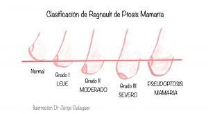 <p>Apariencia visual de caída o flacidez de un órgano o estructura, cuando en realidad el músculo o tejido de soporte no ha descendido.</p>