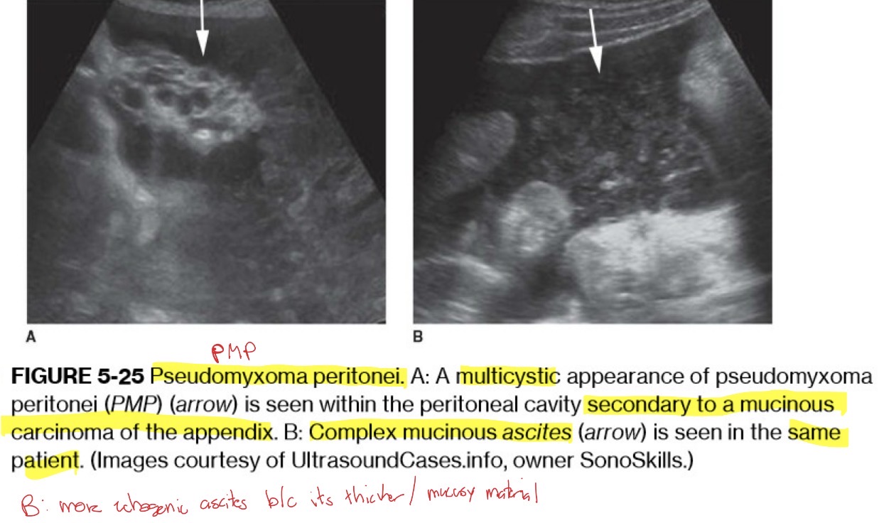 <p>appears as simple or multiloculated ascites but may present as several thin walled cysts varying in sizes scattered throughout peritoneum. rarely appears as hypoechoic solid mass</p>