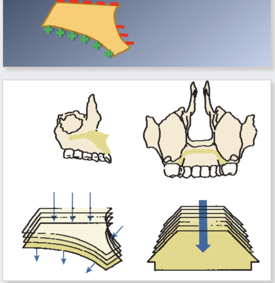 <p><span>5. As the maxilla grows downward and forward, its front surfaces are REMODELED.</span><br><span>1. Front surfaces are remodeled and bone is removed from most</span><br><span>of the anterior surface.</span><br><span>2. Anterior surface is moving forward.</span></p><p><span>5. Remodeling may oppose or produce an additive effect on growth.</span><br><span>1. Additive effect at the palatal bone: bone is removed on the nasal side and added on the oral side</span><br><span>2. Anterior part of the alveolar process is a resorptive area, cancelling part of the forward growth.</span></p>