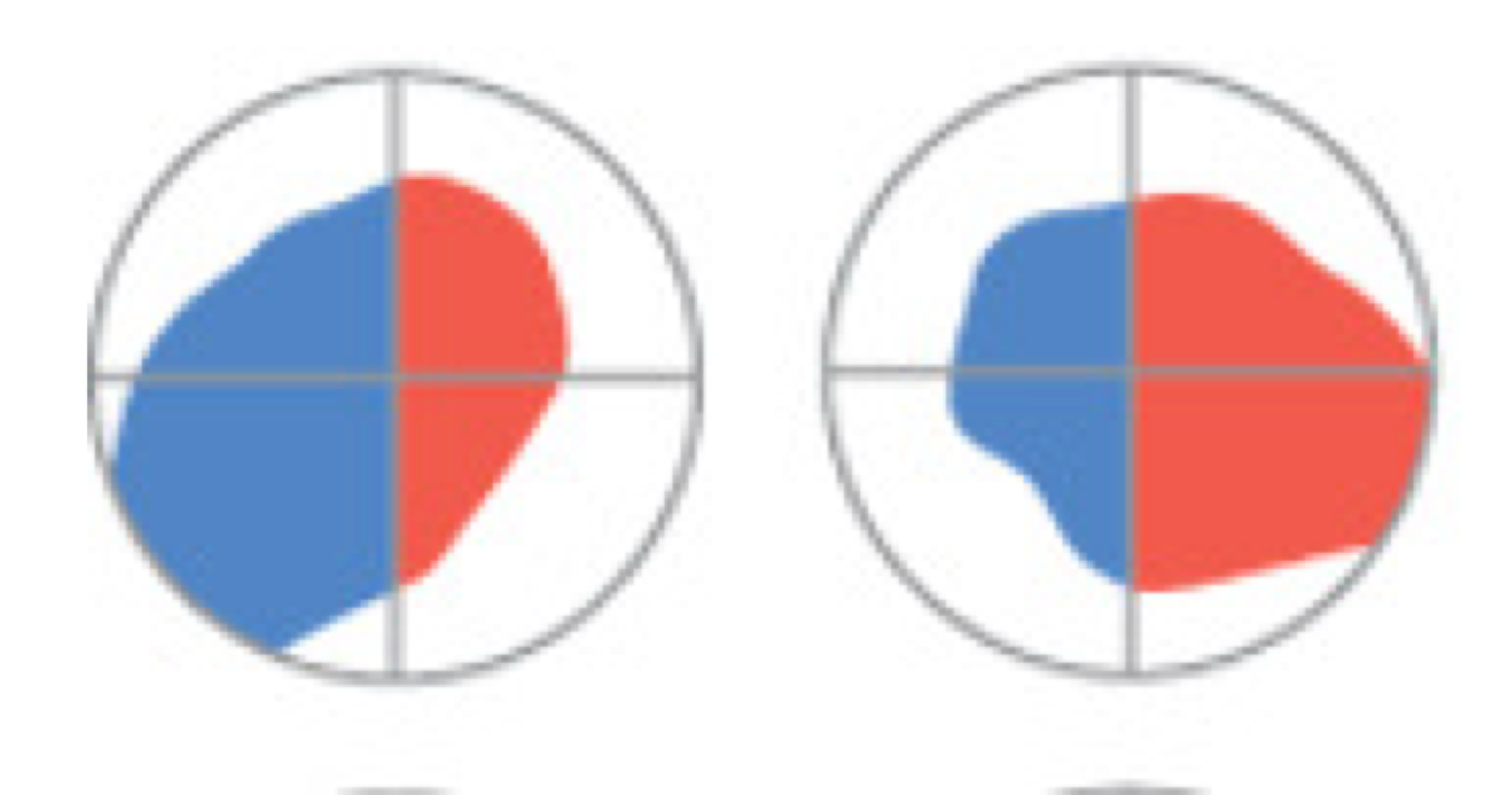 <p>blindness of one visual field due to damage in either: optic tract, LGN, V1</p>