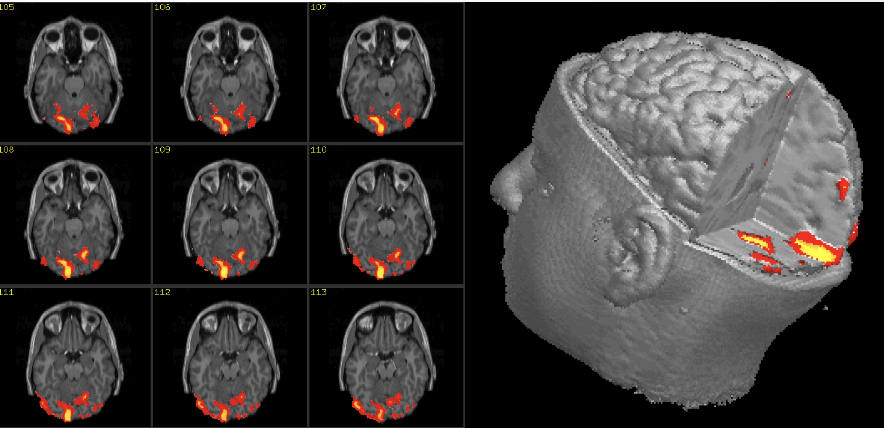 <p>images metabolic function → measures brain activity by detecting changes associated with blood flow</p>