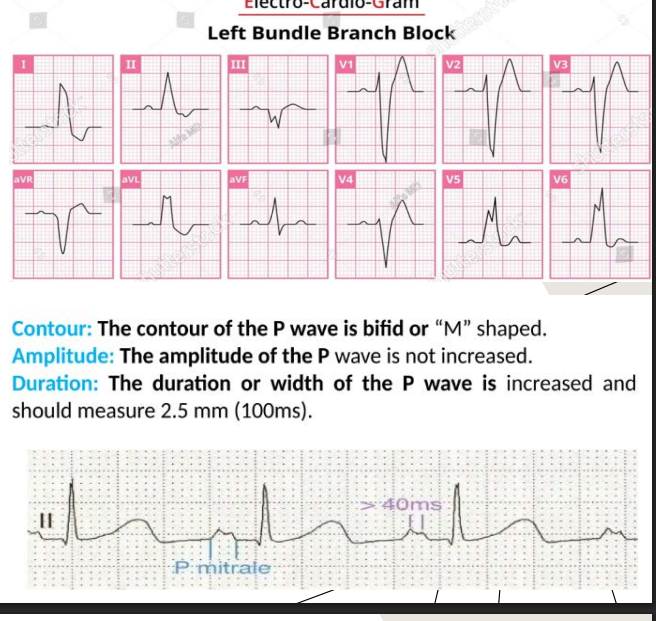 <p>Sinus tachycardia •</p><p>Nonspecific ST-T wave abnormalities •</p><p>Atrial arrythmias or atrial fibrillation •</p><p>Ventricular arrythmias</p><p>• LBBB******</p><p>• Left atrial enlargement*****</p><p>the p-wave is long / the duration or width of the p wave is increased and the amplitude of the p wave is not increased </p>