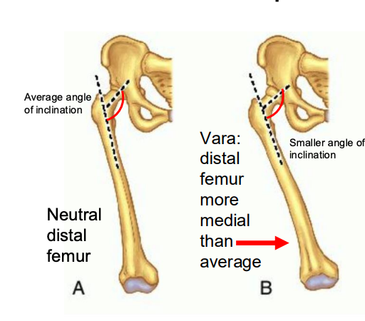 <p>distal femur is more medial than average, femoral angle of inclination is decreased (less than 120 degrees)</p>