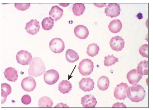 <p>Pyruvate Kinase Deficiency</p>
