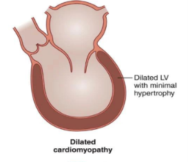 <p>What is <em>Dilated Cardiomyopathy</em>? </p>