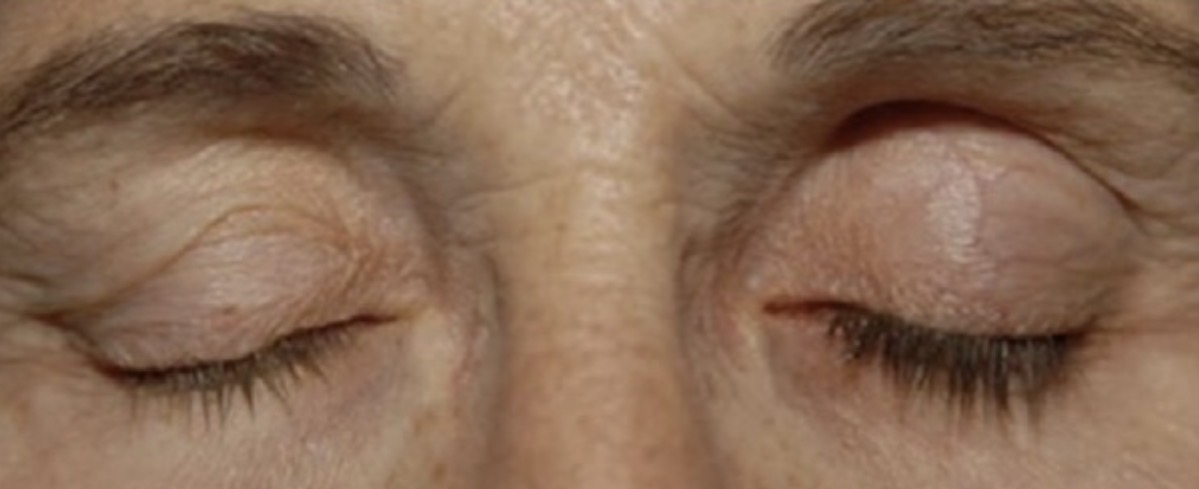 <p><span>À quelle classe d'antiglaucomateux appartient la goutte topique appliquée à l'oeil gauche de ce patient ?</span></p><p></p><p><span>A. ﻿﻿﻿Miotiques</span></p><p><span>B. Alpha-agonistes</span></p><p><span>C. Bêta-bloqueurs</span></p><p><span>D. ﻿﻿﻿Analogues des prostaglandines</span></p>