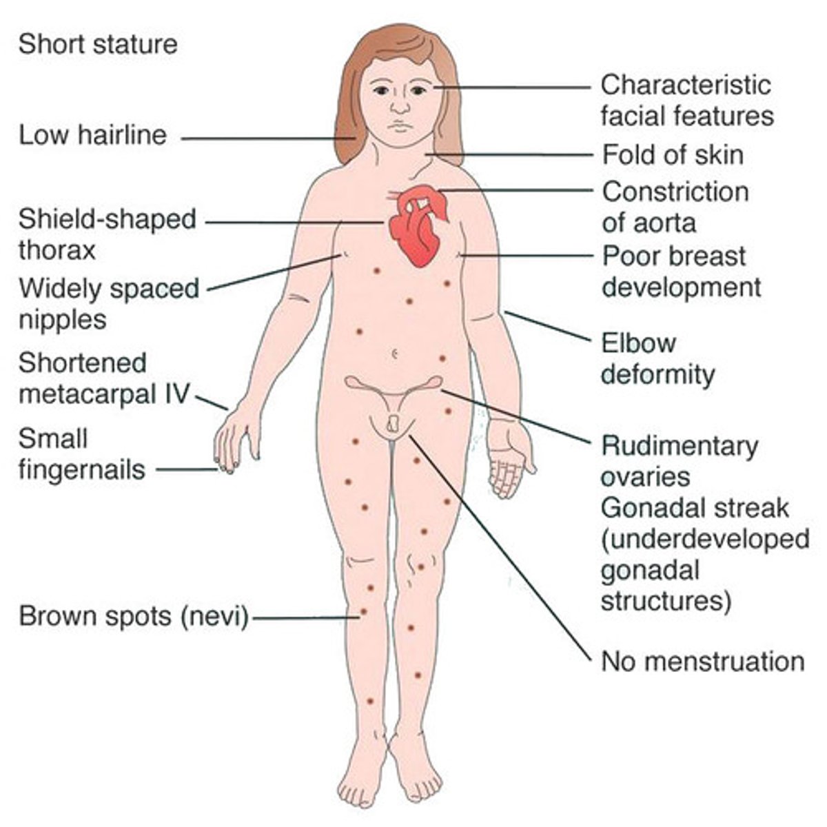 <p>A chromosomal disorder in females in which either an X chromosome is missing, making the person XO instead of XX, or part of one X chromosome is deleted.</p>