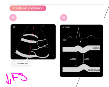<p>A reduced FS suggests LV systolic function seen in dilated CM</p><p>A reduced FS suggests LV systolic dysfunction.”</p>