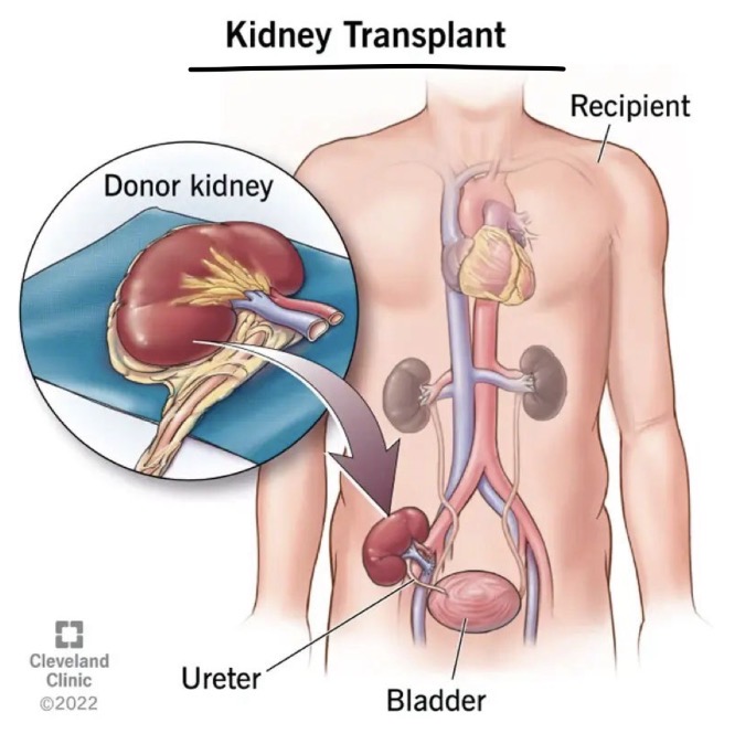 <p>Cut open groin, add 3rd kidney to iliac veins and arteries </p>