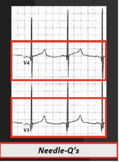 <p><span style="background-color: transparent;">Needle-Q’s or Daggers of Death →<strong> </strong><em>Deep narrow and sharp </em><strong><em>Q waves </em></strong><em>in</em><strong><em> lateral leads (I, aVL, V5-6)</em></strong></span></p><p>Tall R waves on left side (V5, V6) and Deep S in right side (V1, V2, V3)</p>
