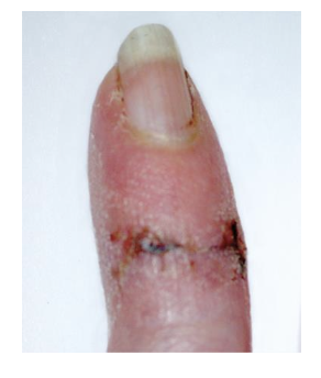 <p>acute inflammation</p>