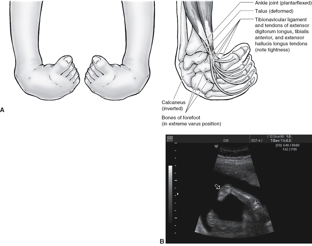 <p>Metatarsals and toes lie in the same plane as the tibia and fibula</p>