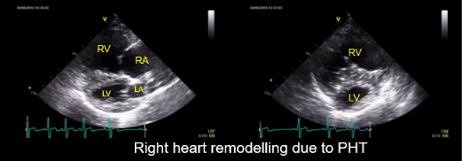 <p>R-CHF → cor pulmonale (due to lung dx e.g. pulmonary fibrosis) </p><p></p>