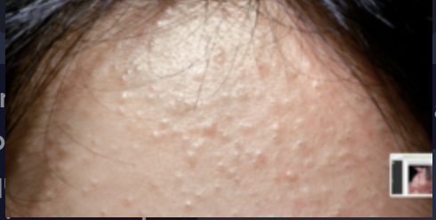 <p>Paciente femenino de 17 años, sana. Acude a consultar porque ha notado cambios en la textura de su piel. A la exploración física, encontramos la dermatosis que se observa en la fotografía. ¿Qué lesiones predominan en este paciente?</p>