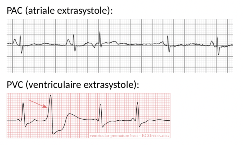 <p>onstaat door extra samenknijpen (te vroege systole) van atrium of ventrikel</p><p>2 soorten</p><ul><li><p><strong>PAC</strong> (premature atriale contractie): smalcomplex - want volgt normale AV-geleiding, P-top andere morfologie dan sinusslag</p></li><li><p><strong>PVC </strong>(premature ventrikelcontractie: breedcomplex - want ontstaat in ventrikel, <u>geen</u> voorafgaande P-top</p></li></ul><p></p><p>de extra kleine slag voelt men niet, maar daarna is langere tijd nodig voor vullen tot volgende slag plaatsvindt</p><ul><li><p>klachten onstaan doordat men wel de slag voelt doe na PAC/PVC komt, omdat hart dan extra gevuld is</p></li></ul><p></p>