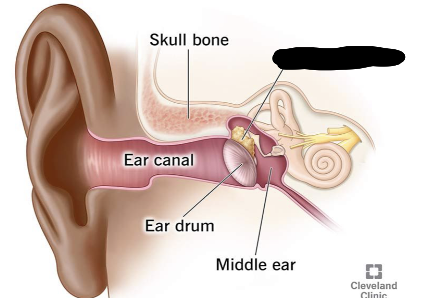 <p>benign growth filled with skin cells/debris </p><p>ETD, retracted eardrum, allergies, URI </p>