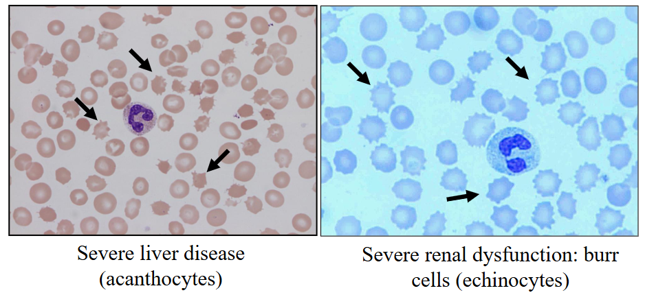 <p>- Liver disease ("spur cell anaemia") and renal failure alter the RBC membrane</p><p>- Infections: can be inside RBC (e.g malaria)</p>