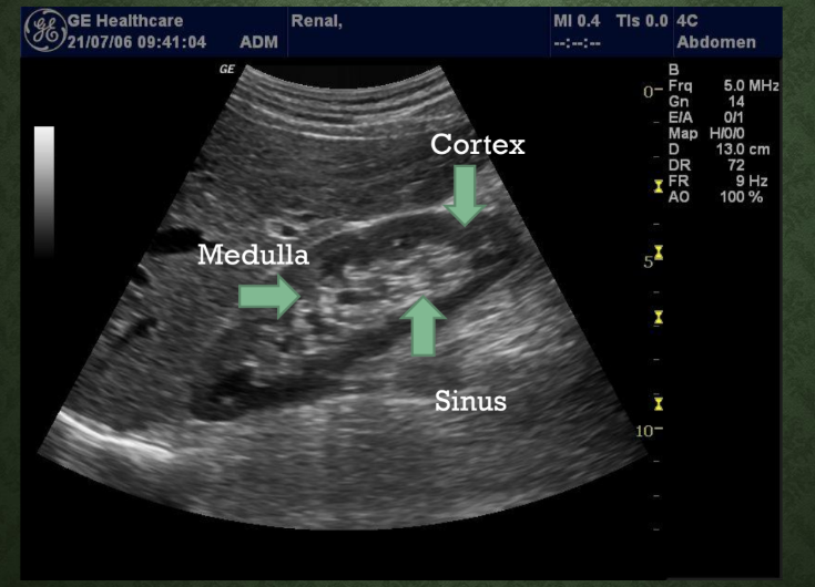 <p>What structure is identified in the center of the kidney on this image?<br>→ Renal pelvis</p>