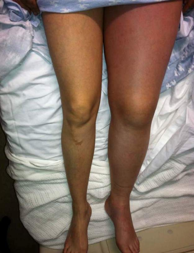 <p>This patient most likely has which of the following pathologies?</p>