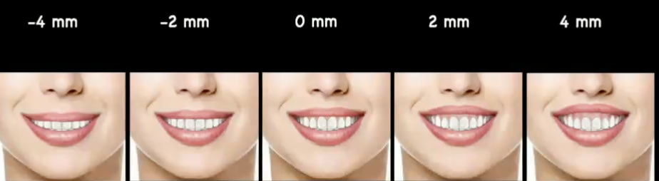 <p>pt preference of anterior dental esthetics, what was found in this study w gingival display at smile </p>
