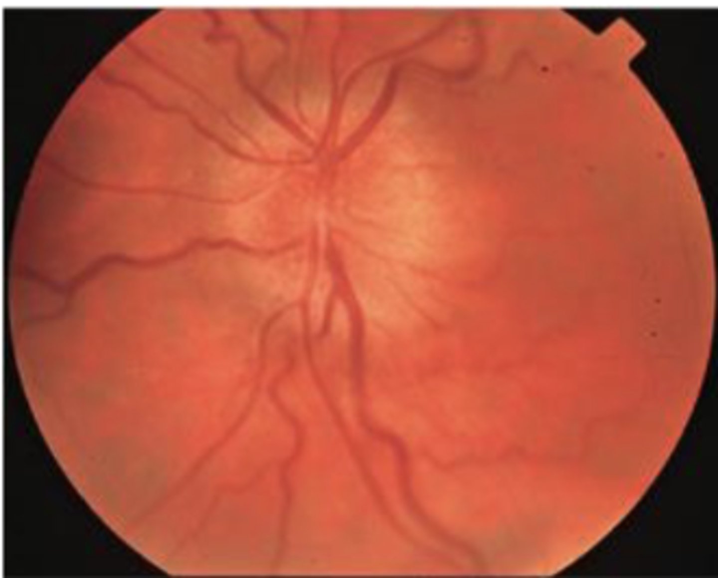 <p>Swelling of the optic disc and anterior bulging of the physiologic cup suggest papilledema , which is optic nerve head swelling associated with increased intracranial pressure</p><p>EMERGENCY => increased ICP</p>