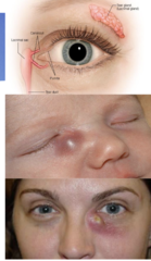 <p>inflammation of the lacrimal sac</p><p>bacterial infection when the nasolacrimal passage is obstructed</p>
