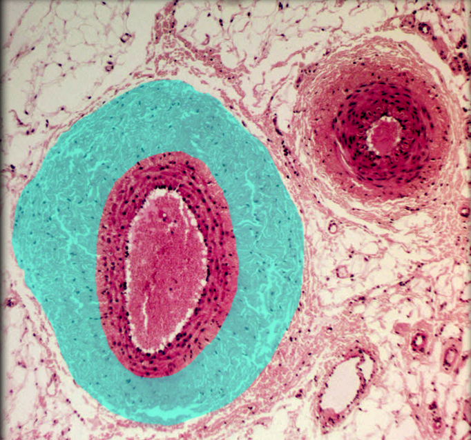 <ul><li><p><strong>Location: </strong>Outermost layer of vessel wall</p></li><li><p><strong>Function:</strong></p><ul><li><p>Vasoconstriction and vasodilation</p></li><li><p>Helps anchor blood vessel to surrounding structures</p></li></ul></li><li><p><strong>Description: </strong>Thickest of three tunics</p></li><li><p><strong>Also known as: </strong>Tunica adventitia of medium sized vein</p></li><li><p><strong>Comment:</strong></p><ul><li><p>In arteries, tunica media is thickest layer; in veins, tunica externa is thickest layer</p></li><li><p>Inner 1/3 of tunica media and all tunica intima supplied by diffusion of oxygen and nutrients from lumen of blood vessel</p></li><li><p>In large vessels, outer 1/2-2/3 of tunica media supplied by nutritive arteries (vasa vasorum) located in tunica externa</p></li></ul></li></ul><p></p>