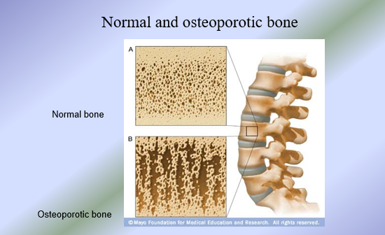 <ul><li><p>Adult bones constantly undergo bone formation on the periosteal surface and bone resorption on the endosteal surface = bone remodeling </p></li><li><p>In healthy adults = bone density remains constant </p><ul><li><p>Rate of bone formation = rate of bone resorption</p></li><li><p>If rate of resorption outpaces the rate of formation = osteoporosis</p></li></ul></li><li><p>Functions of bone remodeling:</p><ul><li><p>To maintain calcium homeostasis</p></li><li><p>To allow for bone repair after fractures</p></li></ul></li><li><p>Bone Turnover</p><ul><li><p>Bone remodeling characterized by two activities</p><ul><li><p>Resorption of old bone by osteoclasts </p></li><li><p>Formation of new bone by osteoblasts</p></li></ul></li></ul></li></ul><p></p>