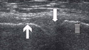 <ul><li><p><span style="background-color: transparent;">Found in the menisci (knee)&nbsp;and intervertebral disc spaces (back)</span></p><ul><li><p><span style="background-color: transparent;">Function - shock absorption</span></p></li></ul></li><li><p><span style="background-color: transparent;">Appearance - homogeneous and medium echogenicity</span></p></li></ul><p></p>