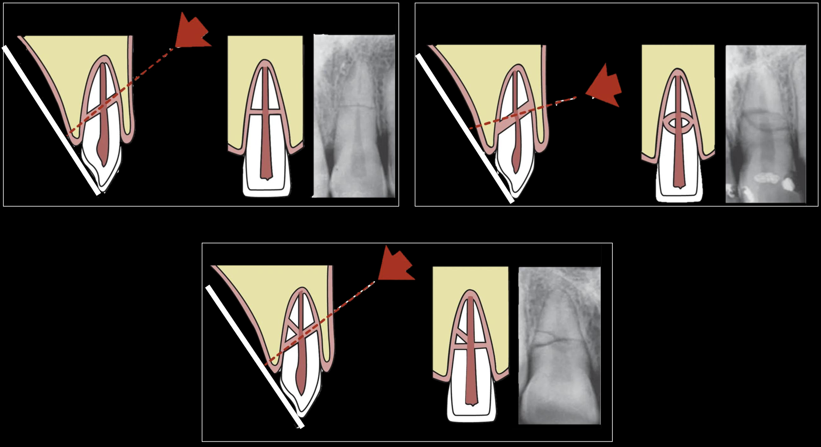 <p>the fracture can appear different on radiographs, need multiple angles to confirm number of fractures </p>