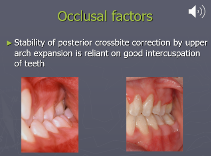<ul><li><p>Good intercuspation of the teeth</p></li><li><p>Affecting left buccal quadrant - correction with expansion - there is good buccal overbite and intercuspation which helps prevent relapse</p></li></ul><p></p>